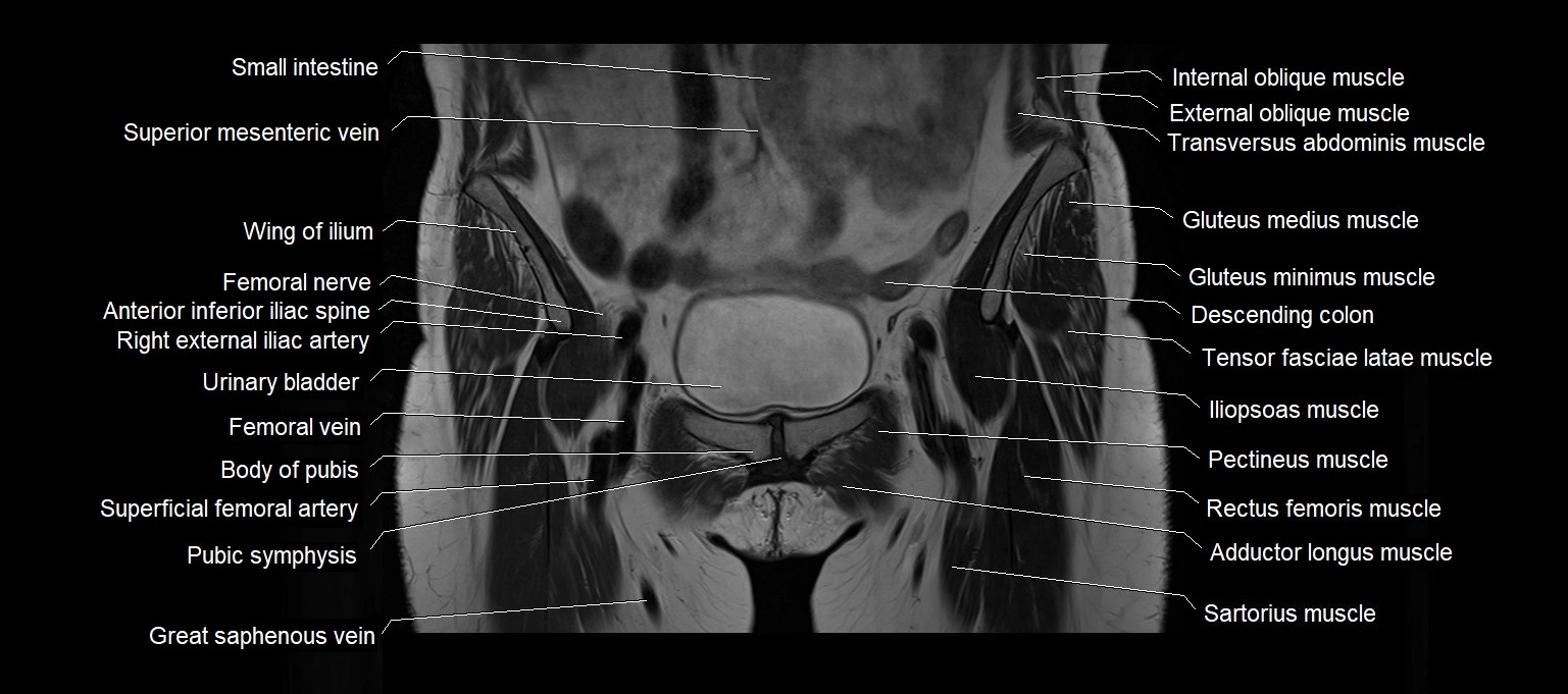 MRI 3T pelvis coronal cross section anatomy image 6.webp
